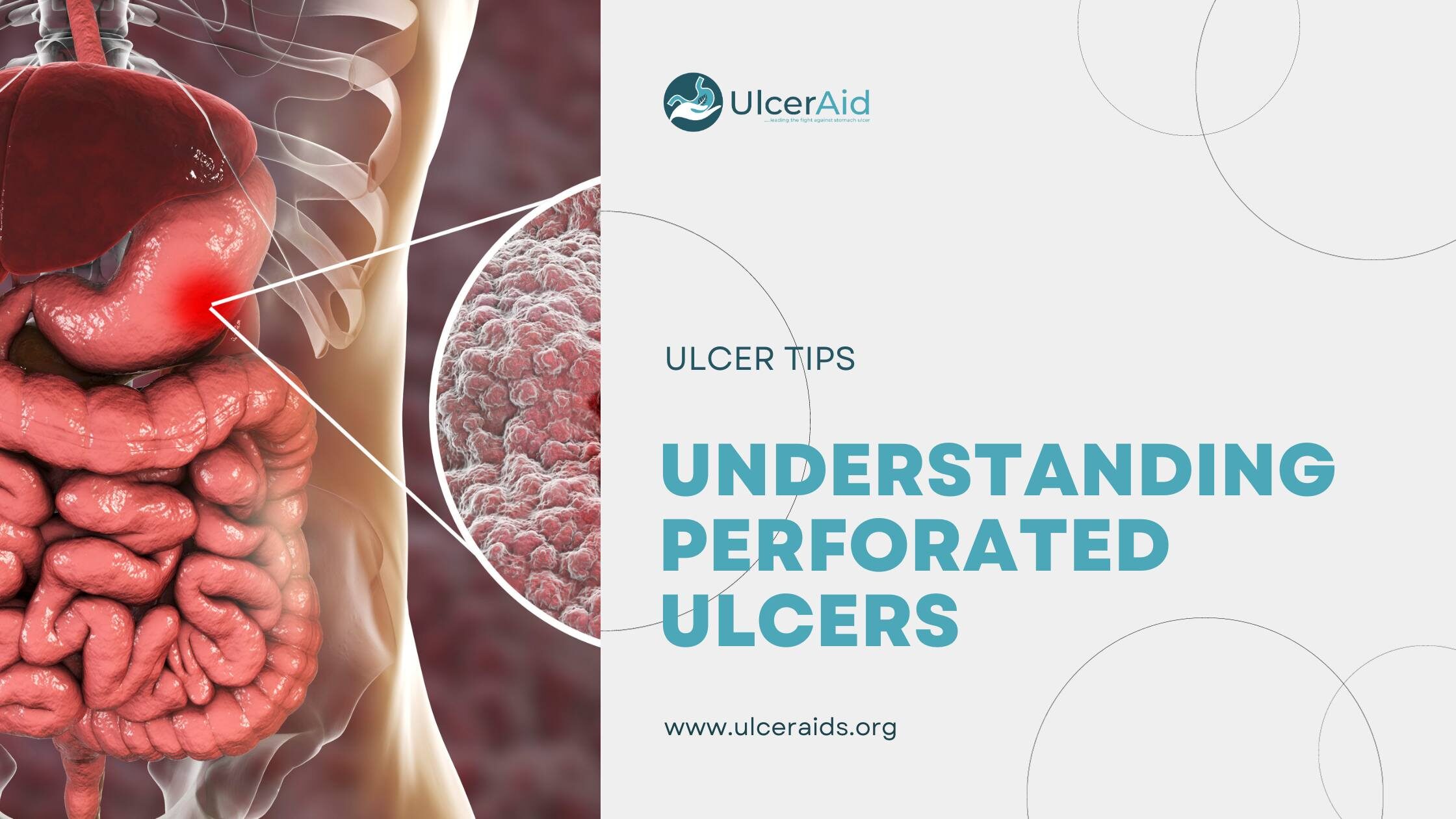 understanding perforated ulcers